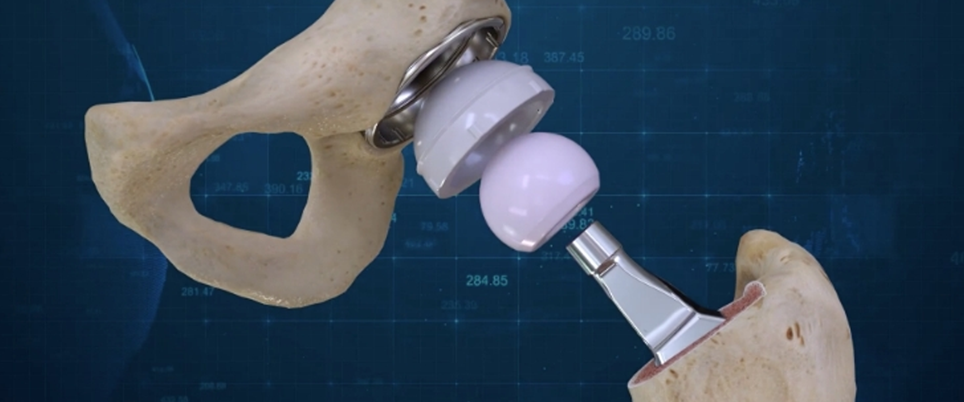 Hip Replacement In India